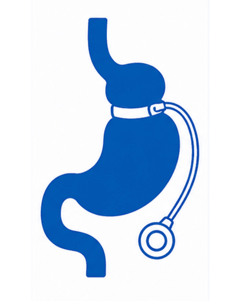 Adjustable Gastric Band