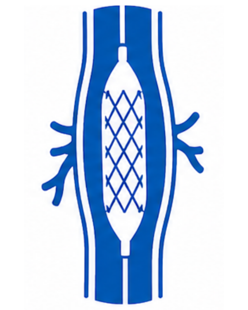 Angioplasty & Stenting_GHB