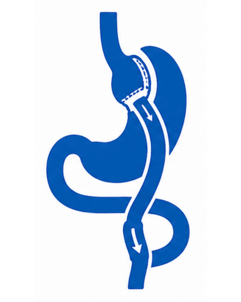 Gastric Bypass