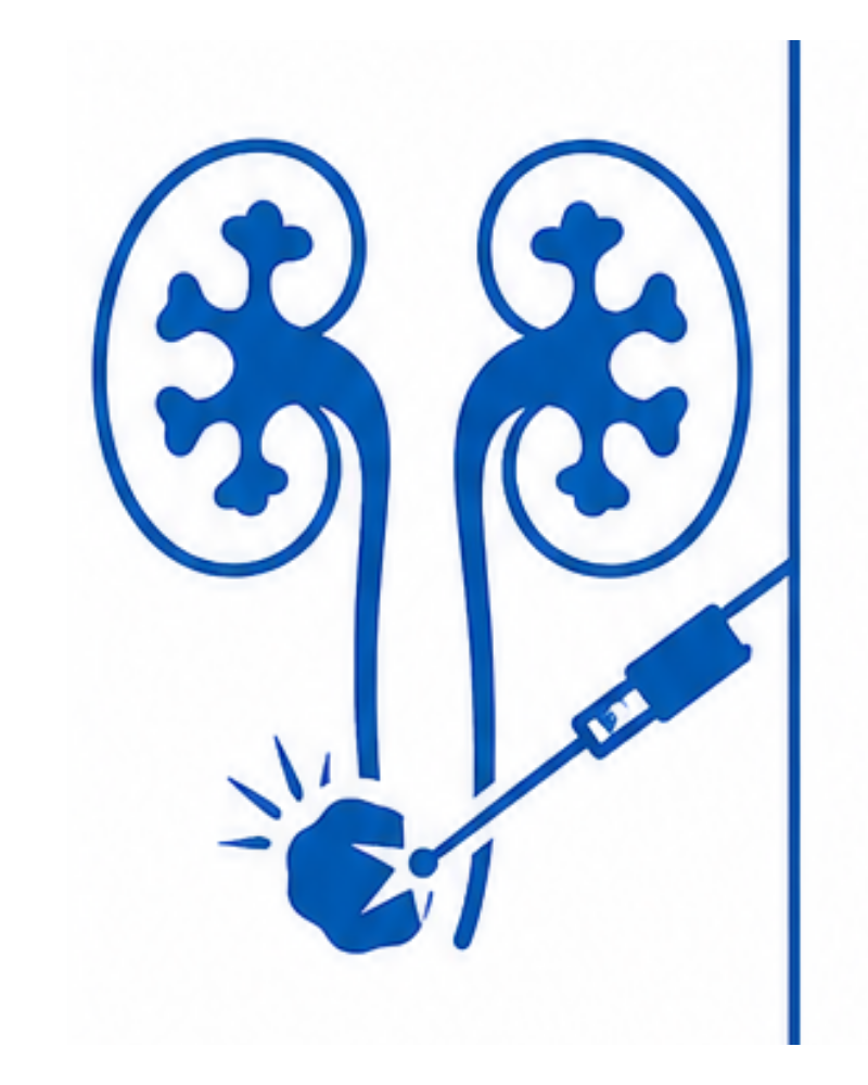 Kidney Stone Treatment