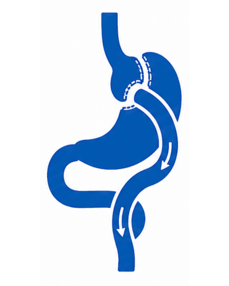 Mini Gastric Bypass