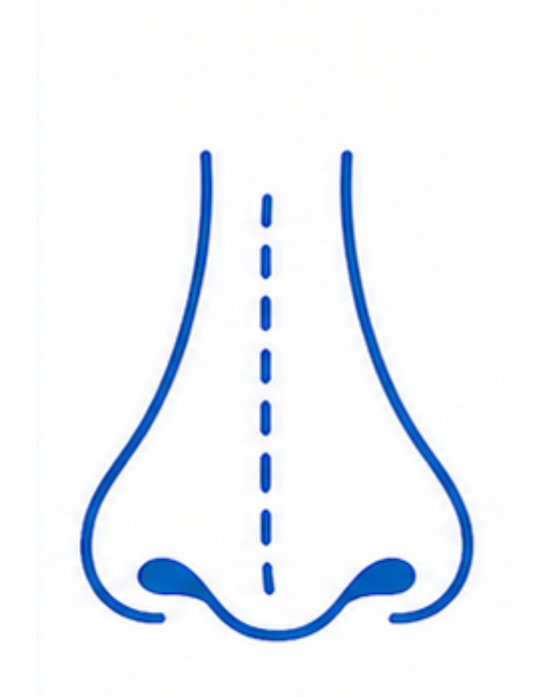Septoplasty