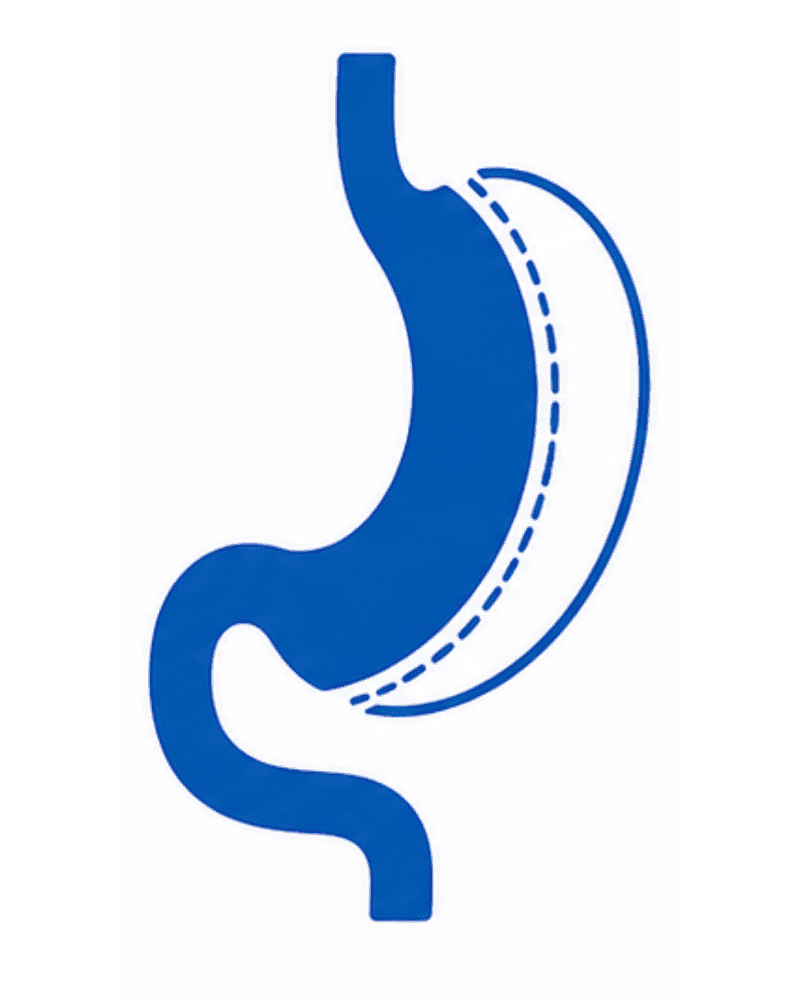 Sleeve Gastrectomy (Gastric Sleeve)
