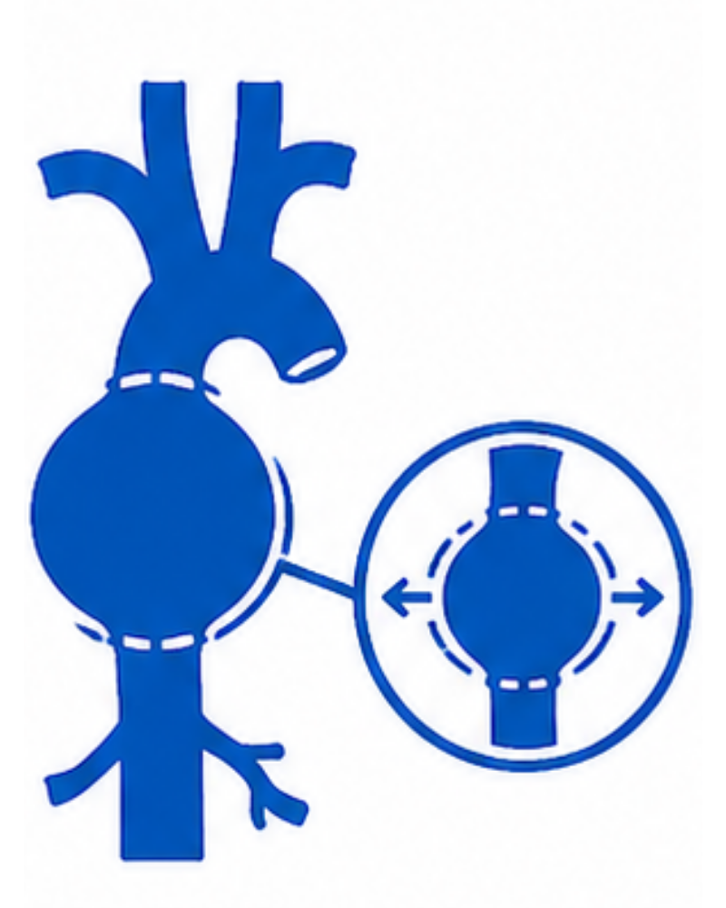 Aneurysm Repair
