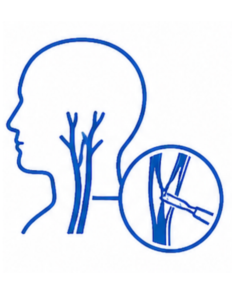 Carotid Artery Surgery