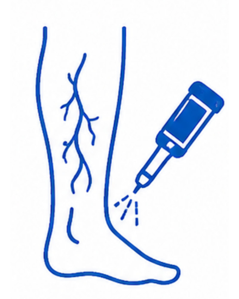 Varicose Vein Treatment