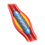 Angioplasty_N