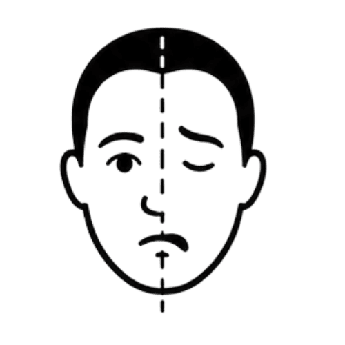 Bell's Palsy