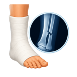 Fracture Care