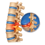 Spine-Related Neurological Care