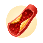 High Cholesterol