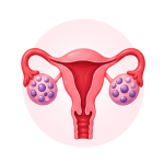 PCOS